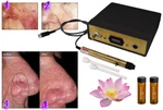 New Avance Laser Spider Varicose Vein Reduction Machine, Permanent Results. Fixed Price $999.95.